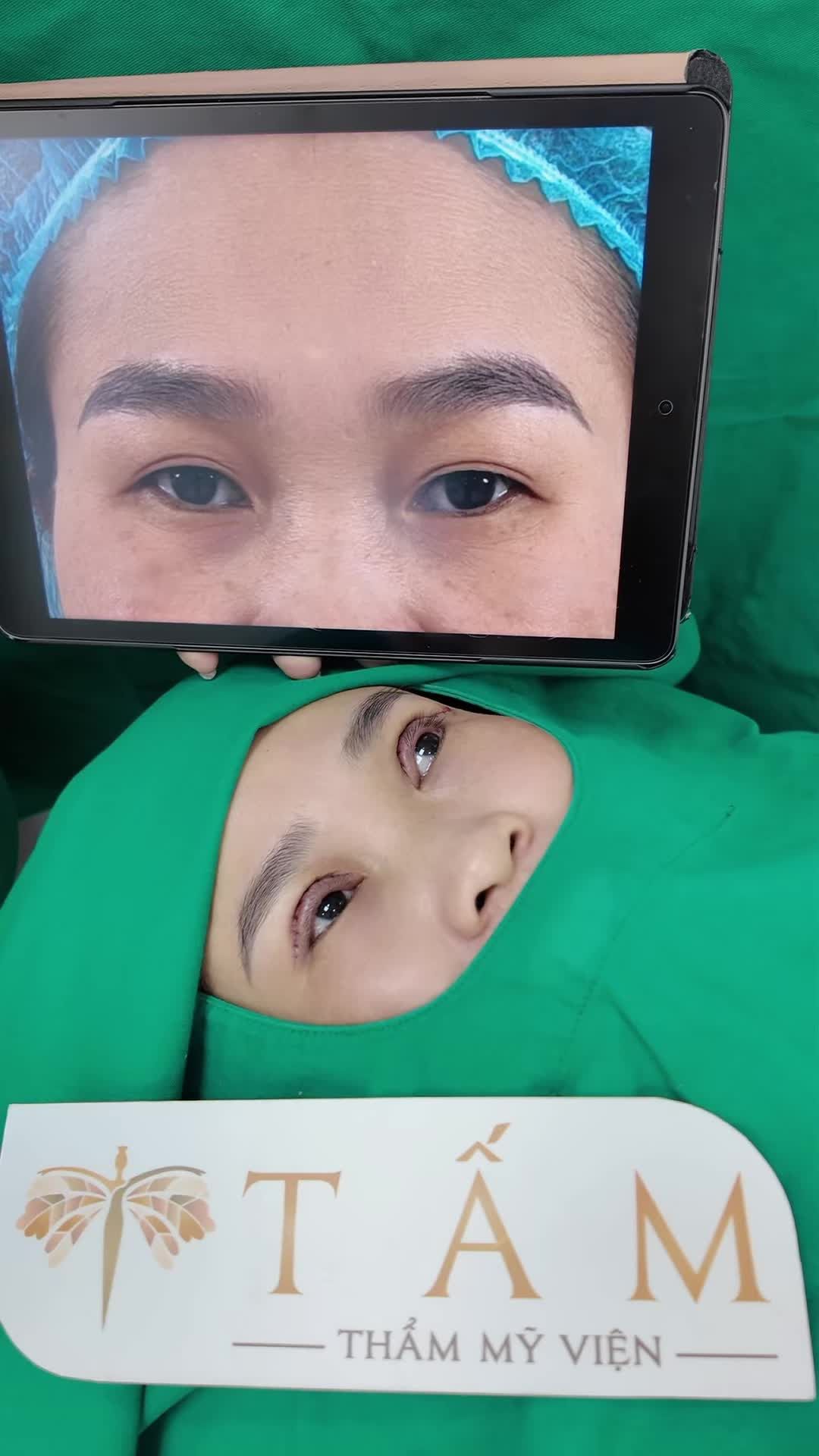 Da dư chùng làm mắt bị sụp, không rõ nếp mí. Chỉ sau 30 phút tại Tấm, đôi mắt trở nên hài hoà, sắc nét hơn rất nhiều.