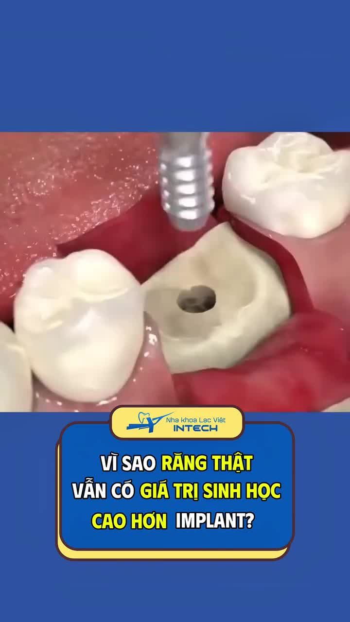 Vì sao răng implant không thể thay thế răng thật?