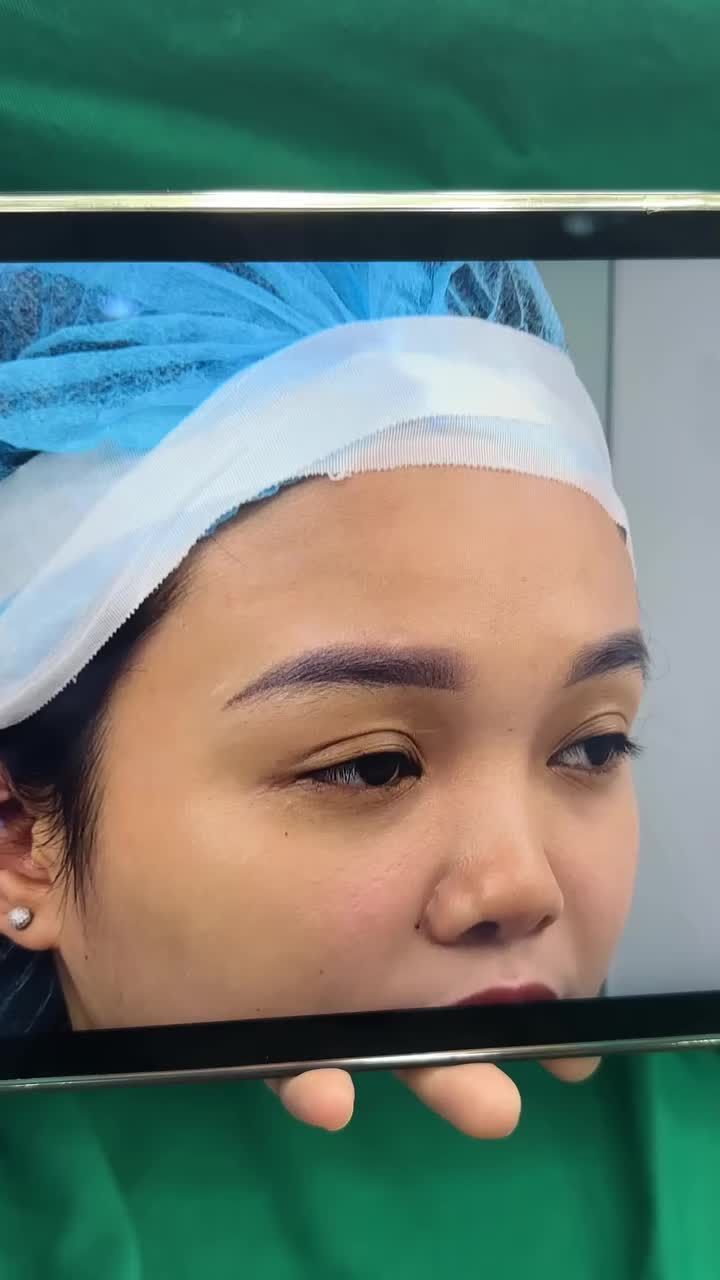 Đầu mũi ngắn, hở và hếch – khuyết điểm khá phổ biến khiến nhiều bạn mất tự tin.