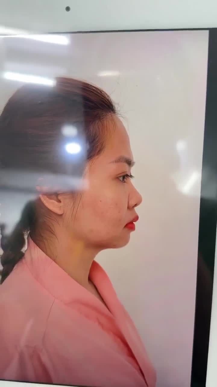 KẾT QUẢ SAU 60 PHÚT NÂNG MŨI CẤU TRÚC DR. HOẠT