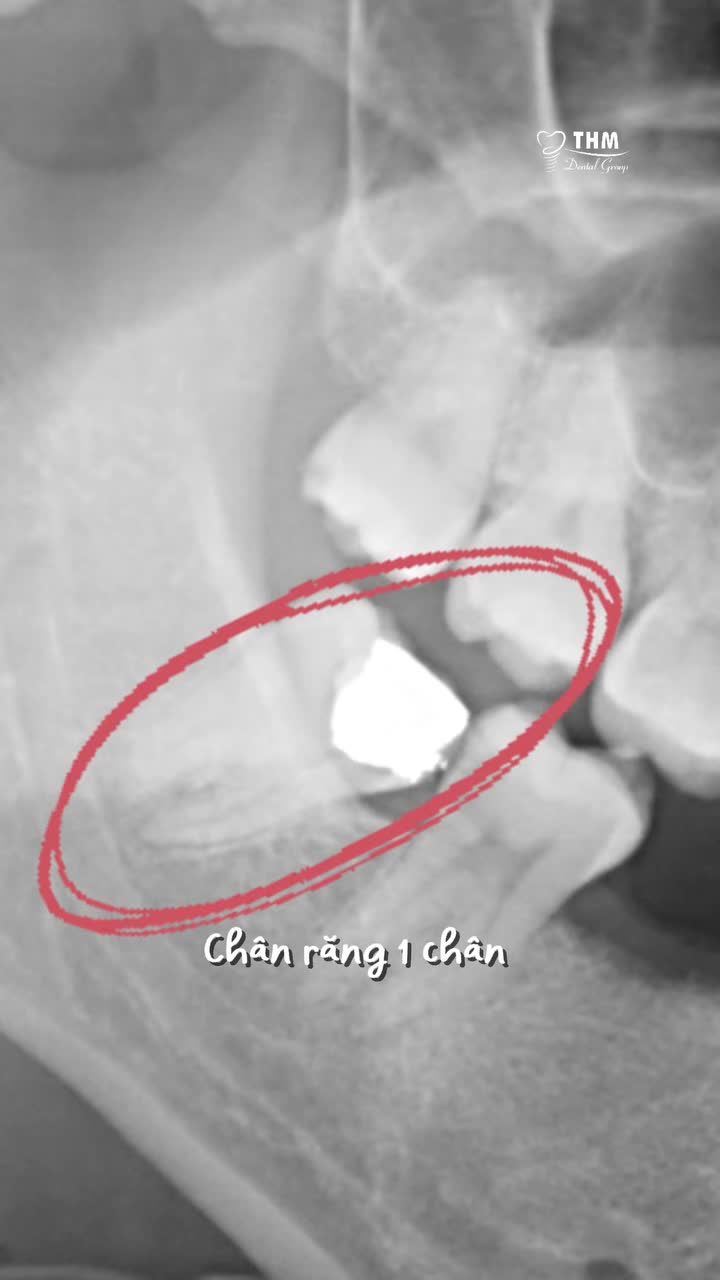 Những lưu ý khi di gần răng 7 và 8 trong trường hợp mất răng 6.