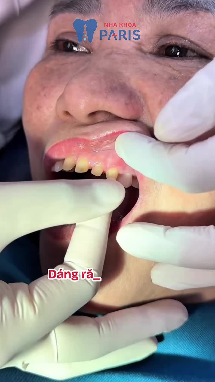 Chỉ sau 2 lần hẹn tại Nha khoa Paris. Bác gái đã lấy lại được nụ cười tuổi 20 của mình.