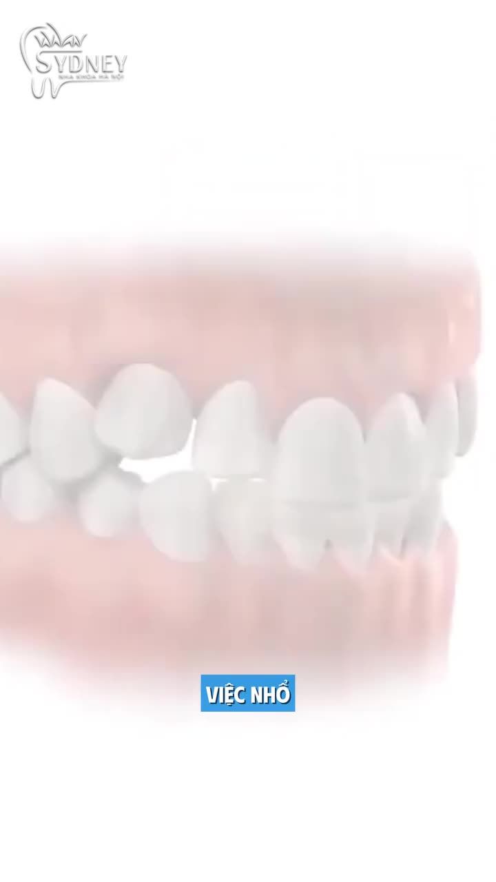 Nhổ răng chỉnh nha thường là răng nào?