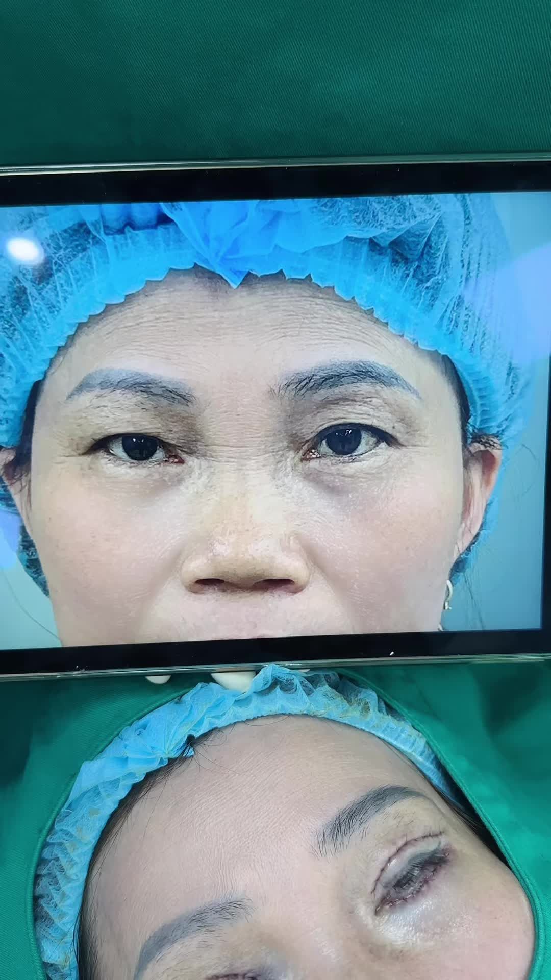 Tạo hình nếp mí đôi chuẩn đẹp cho khách hàng nhà Tấm.