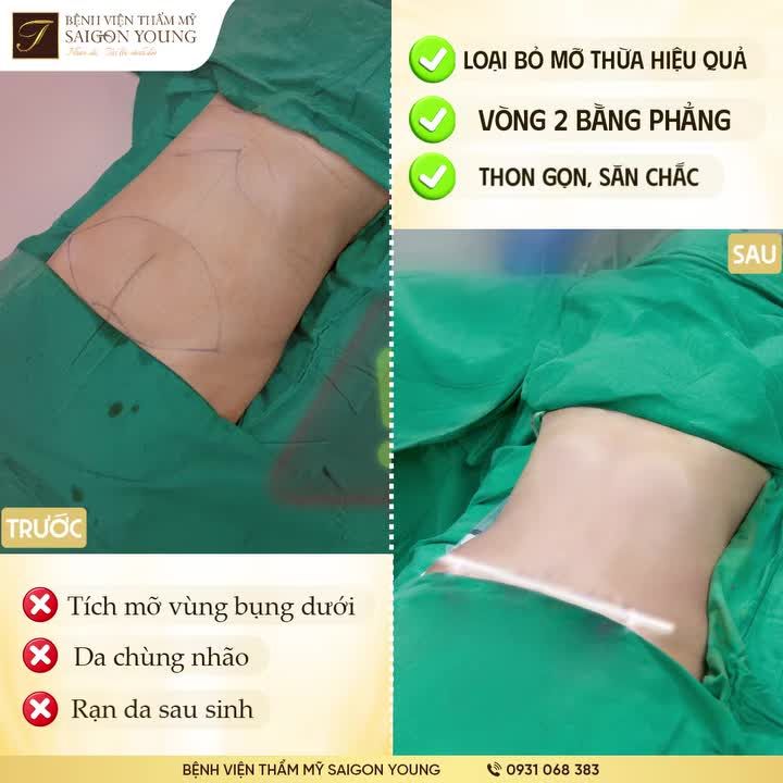 TÁI TẠO VÒNG 2 THON GỌN SAU SINH  Dứt điểm mỡ thừa, da lỏng lẽo và rạn da