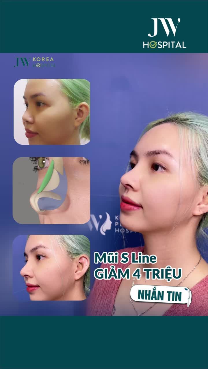 CHẤN ĐỘNG: CÔ GÁI 9X XÓA MŨI TẸT, ĐỔI VẬN GIÀU SANG SAU 60 PHÚT NÂNG MŨI S LINE TẠI JW