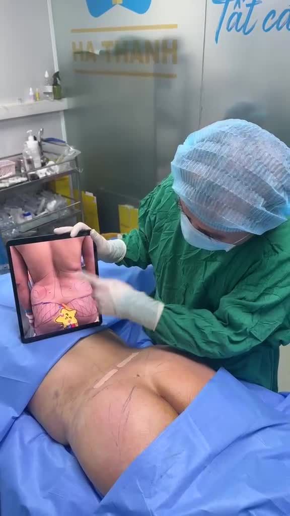 Siết hông-eo và cấy mỡ tròn đầy mông !