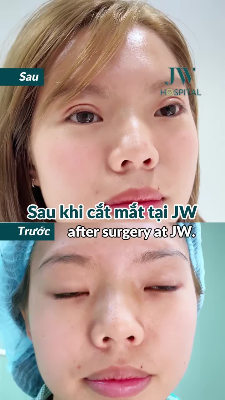 THOÁT 10 NĂM MẶC CẢM VÌ MÍ LÓT, GEN Z VIỆT KIỀU MỸ XINH NHƯ BÚP BÊ SAU CẮT MẮT TẠI JW