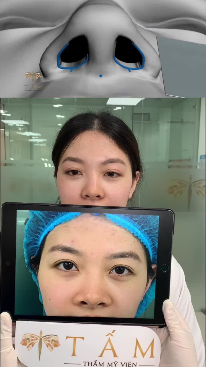 Cận cảnh ca cắt chỉ sau 7 ngày cho bạn khách hàng thu nhỏ cánh mũi bên TMV Tấm.