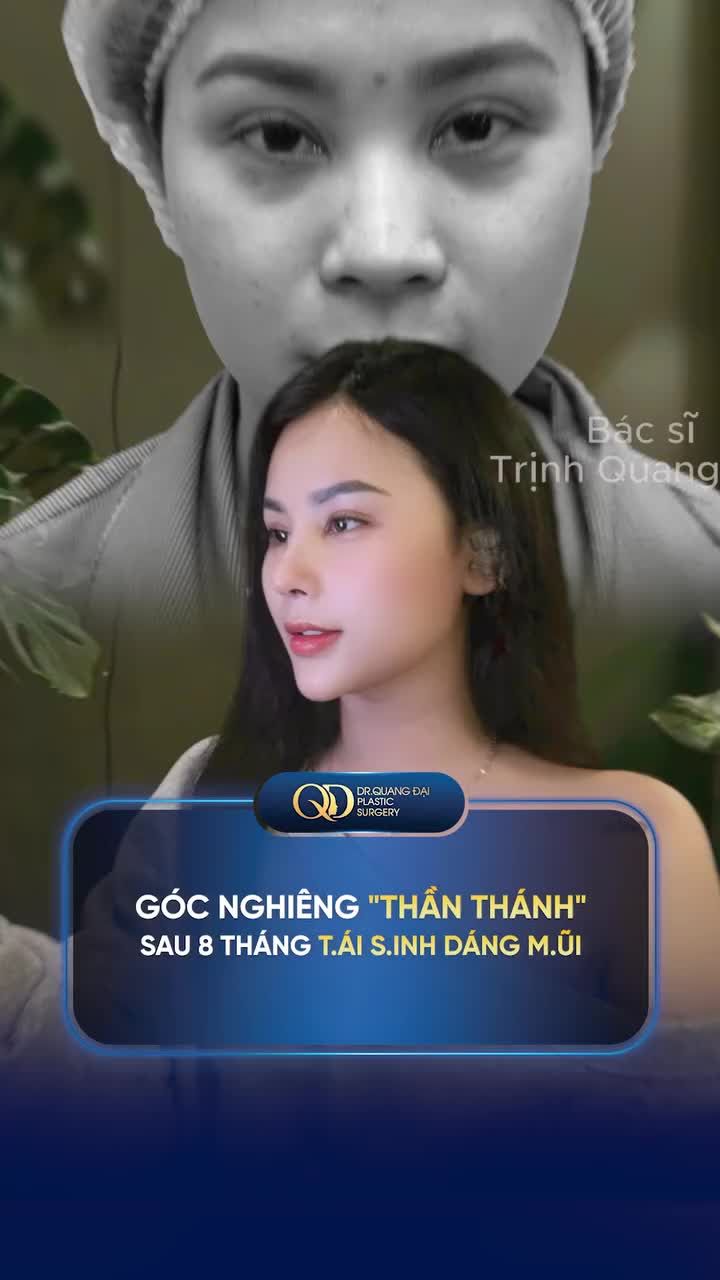 GÓC NGHIÊNG "THẦN THÁNH" SAU 8 THÁNG SỬA LẠI DÁNG MŨI