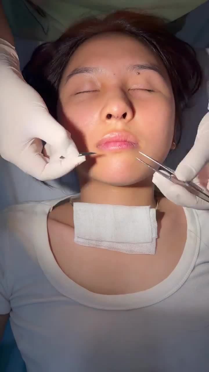 Nóng nhất lúc này: GEN Z hóa minh tinh Hàn Quốc hậu NÂNG MŨI S LINE 3D tại Bệnh viện JW