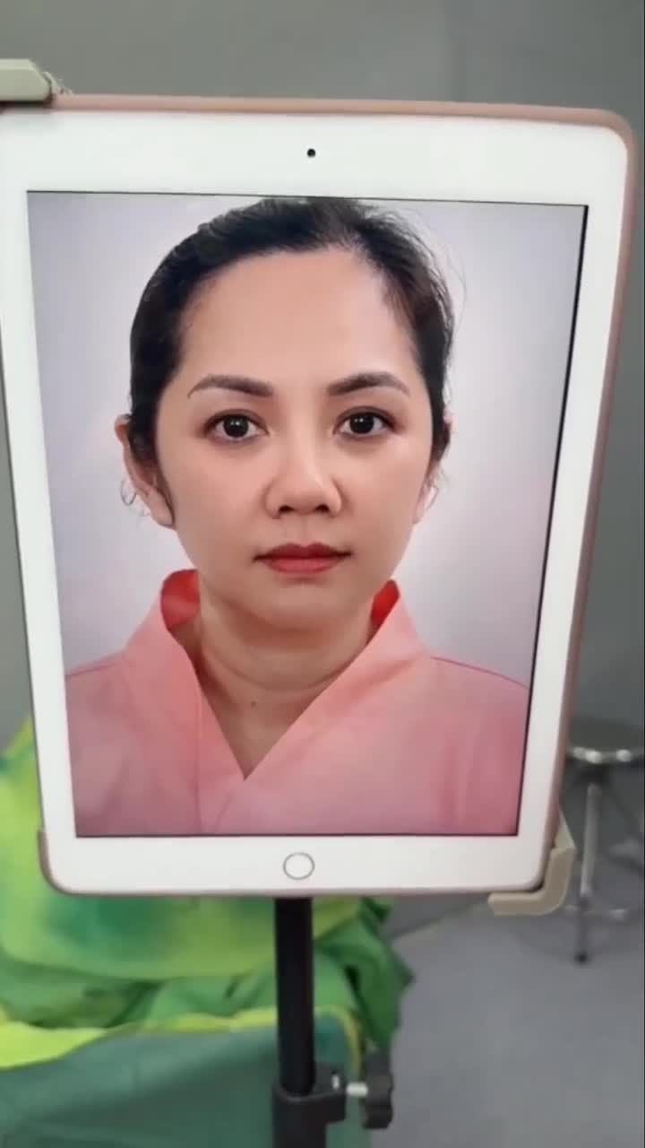 KẾT QUẢ SAU 60 PHÚT NÂNG MŨI CẤU TRÚC DR. HOẠT KH. THÚY PHƯỢNG