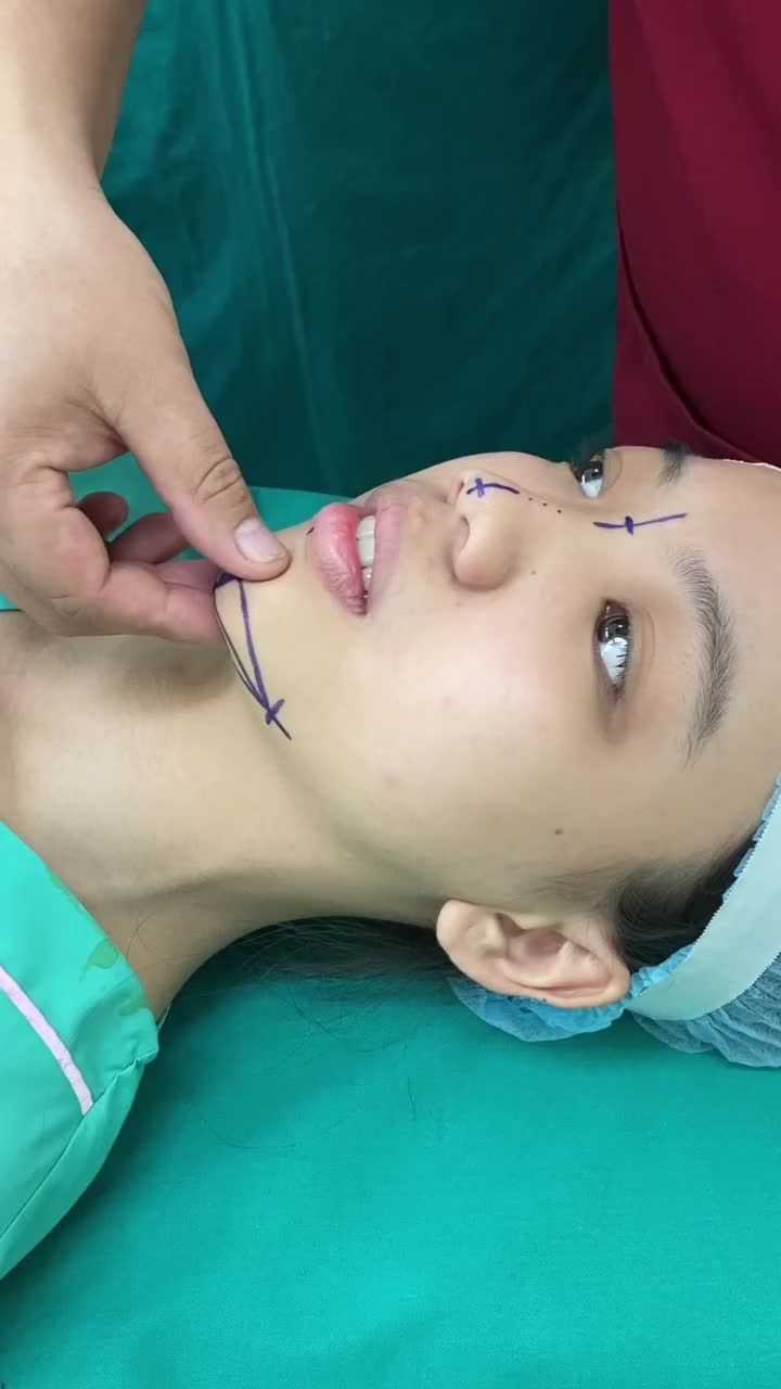 ''Lột xá.c'' xinh đẹp với combo Mũi + Cằm chỉ sau 1 lần thực hiện - Đẹp thanh tú, cuốn hút và tự nhiên!!