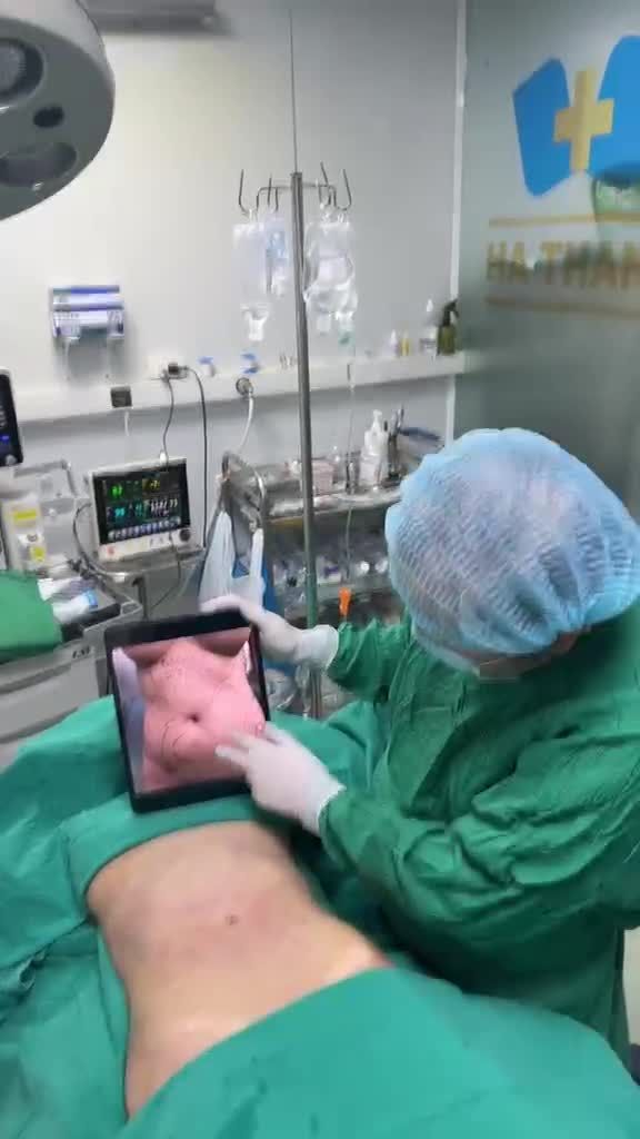 Hút mỡ bụng với Dr Vương