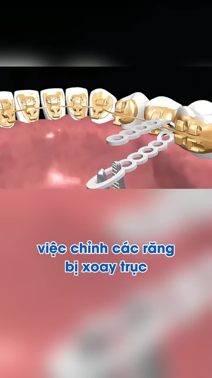 Mỗi khí cụ một nhiệm vụ giúp răng đều đẹp từng ngày