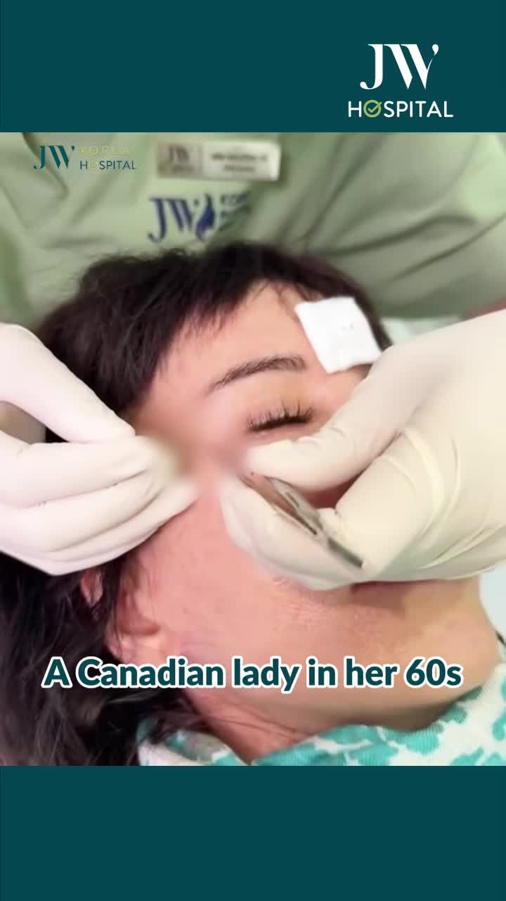 BÁC SĨ TÚ DUNG CẮT DA, NÂNG CƠ MÍ MẮT TẠI JW TRẺ 10 TUỔI CHO QUÝ BÀ CANADA U60