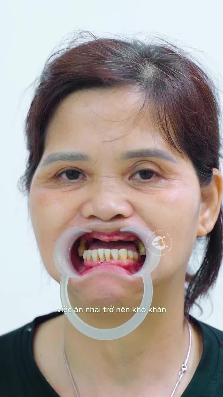 MẤT RĂNG - NGUY CƠ ÂM THẦM ẢNH HƯỞNG HỆ TIÊU HÓA