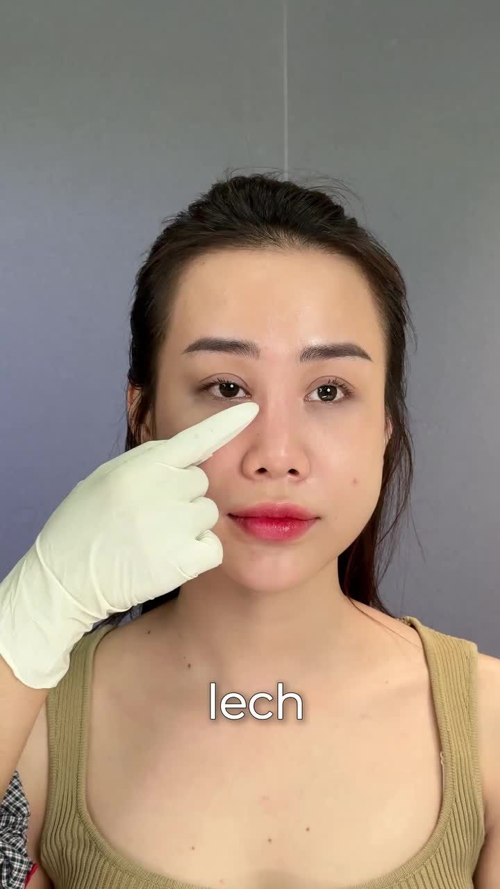 Đã từng nâng mũi chỉ nhưng bị biến chứng lệch sóng, đầu mũi hếch....Bạn đã lựa chọn nâng mũi sửa lại Tuấn Linh và cái kết THẬT ĐÁNG KINH NGẠC