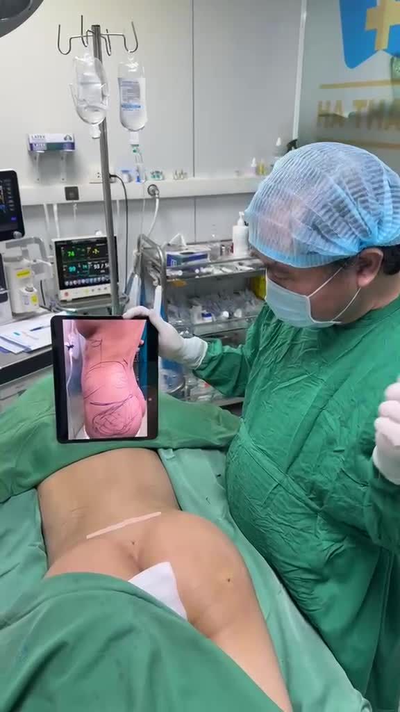 Chỉ hút mỡ chỉnh bụng eo và cấy mỡ mông đã có siêu dáng tuyệt vời !