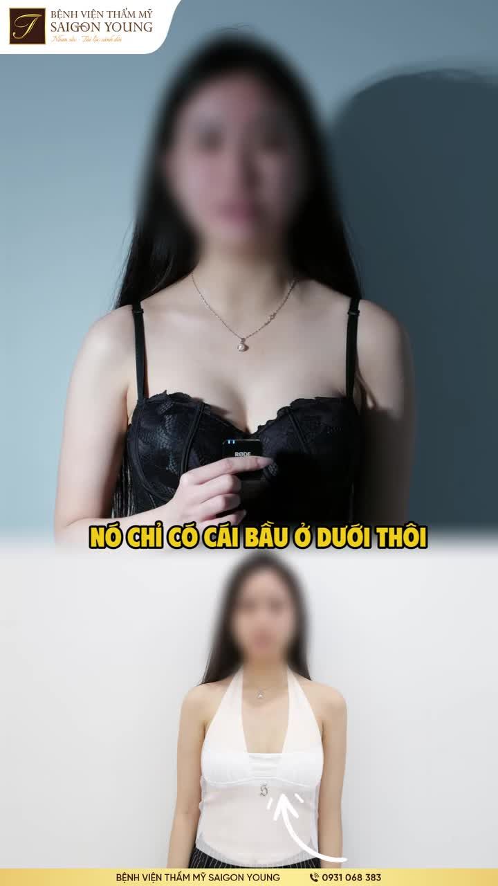 Sau 1 tháng nâng vòng 1 sẽ như thế nào?