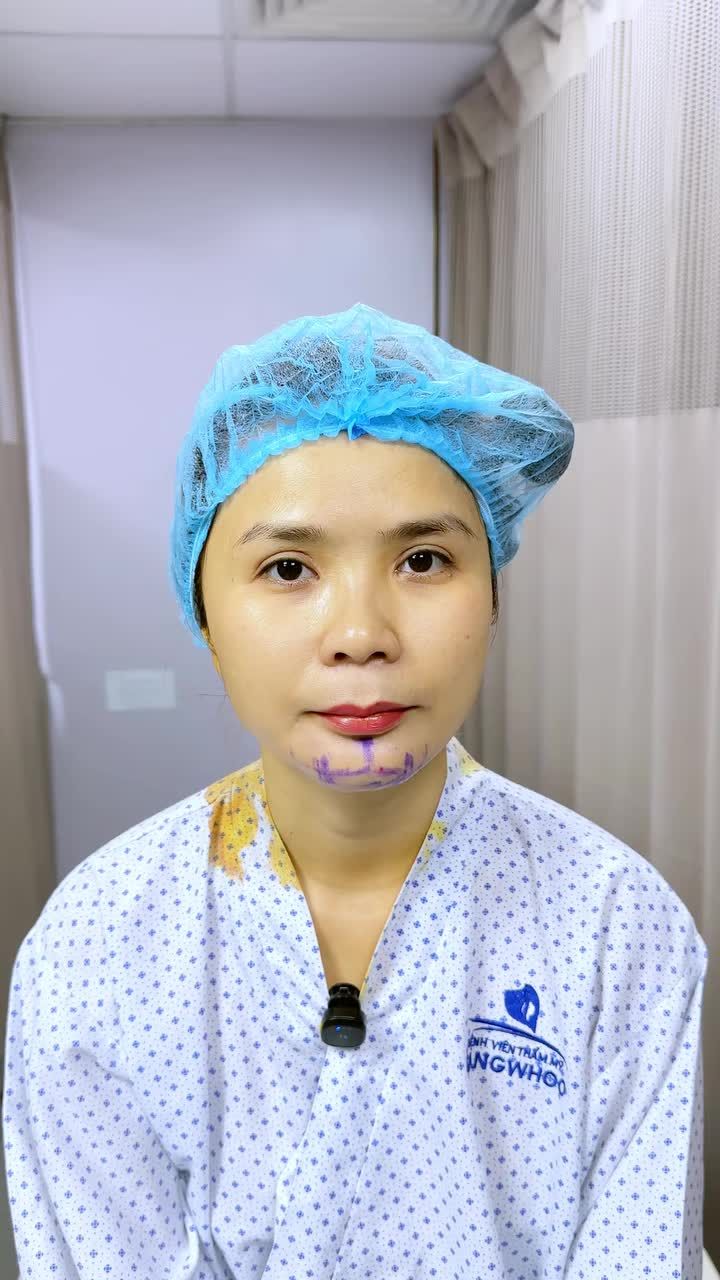 CẬN CẢNH KẾT QUẢ ĐỘN CẰM SAU 60 PHÚT: GƯƠNG MẶT THANH THOÁT, CHUẨN V-LINE