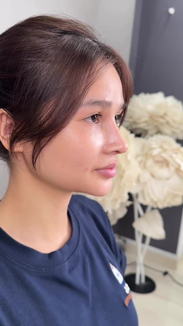 Mũi cấu trúc surgi sau 1 tháng