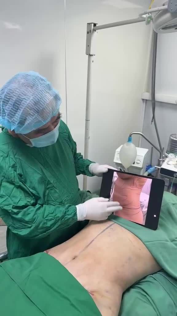 Hút mỡ + Tạo hình thành bụng với Dr Vương: biến BỤNG chum = Rõ eo !