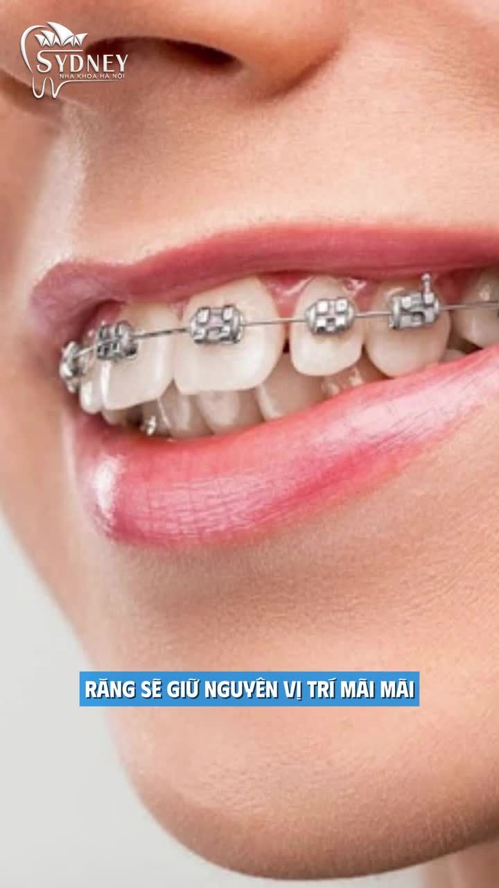 Tại sao răng đã niềng vẫn có thể bị chạy lại?