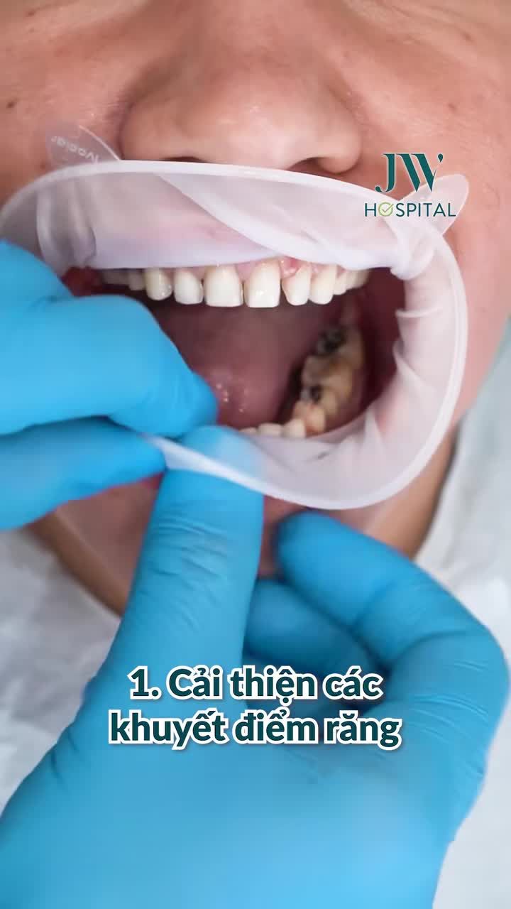 CHẤN ĐỘNG: CHỈ 2% NGƯỜI BIẾT ĐẾN 5 LỢI ÍCH VÀNG CỦA DÁN SỨ VENEER ĐỂ SỞ HỮU NỤ CƯỜI ĐẸP CHUẨN HÀN