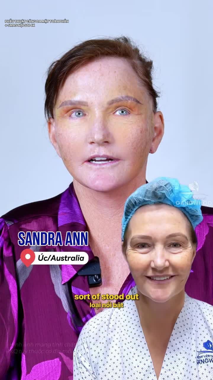 Lý do hàng ngàn khách hàng Quốc Tế tin tưởng và lựa chọn Bệnh viện thẩm mỹ Gangwhoo để phẫu thuật căng da mặt toàn phần +Smas nội soi 4K