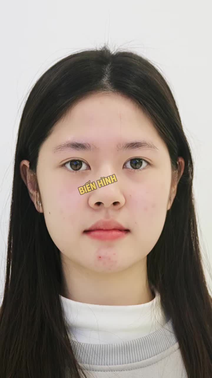 Trước khi niềng răng, Ngọc Anh đã rất xinh xắn và đáng yêu. Tuy nhiên, tình trạng hàm răng cắn ngược (móm) khiến bạn chưa thật sự tự tin khi cười.