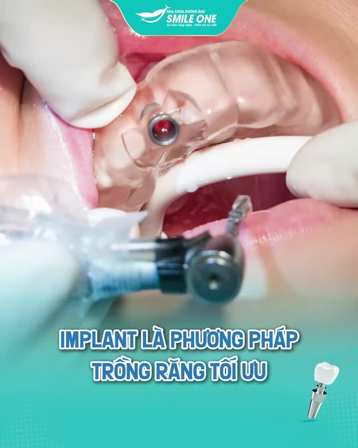 ĐỪNG BIẾN VIỆC TRỒNG RĂNG THÀNH "CANH BẠC" SỨC KHỎE!