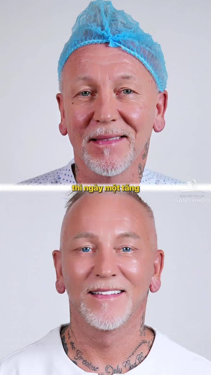 Lý do phẫu thuật căng da mặt toàn phần + Smas nội soi 4K tại Bệnh viện thẩm mỹ Gangwhoo luôn được đông đảo khách hàng trong nước - khách hàng Việt Kiều - khách hàng Quốc tế tin tưởng lựa chọn