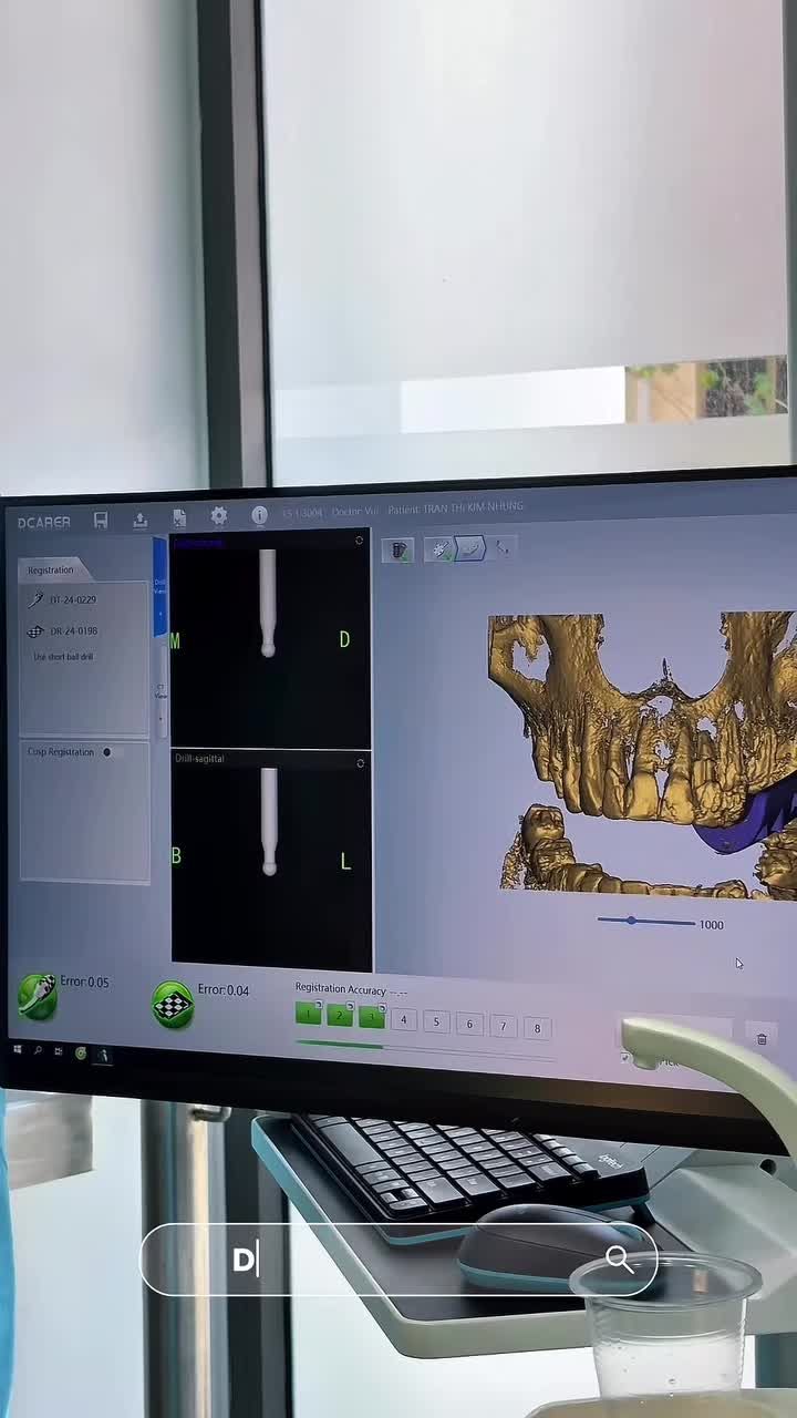 Implant gì chưa ngừ đẹp ??