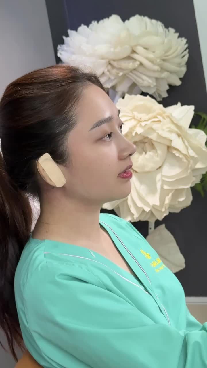 NÂNG MŨI CẤU TRÚC – HOÀN THIỆN DÁNG MŨI THANH TÚ TỰ NHIÊN