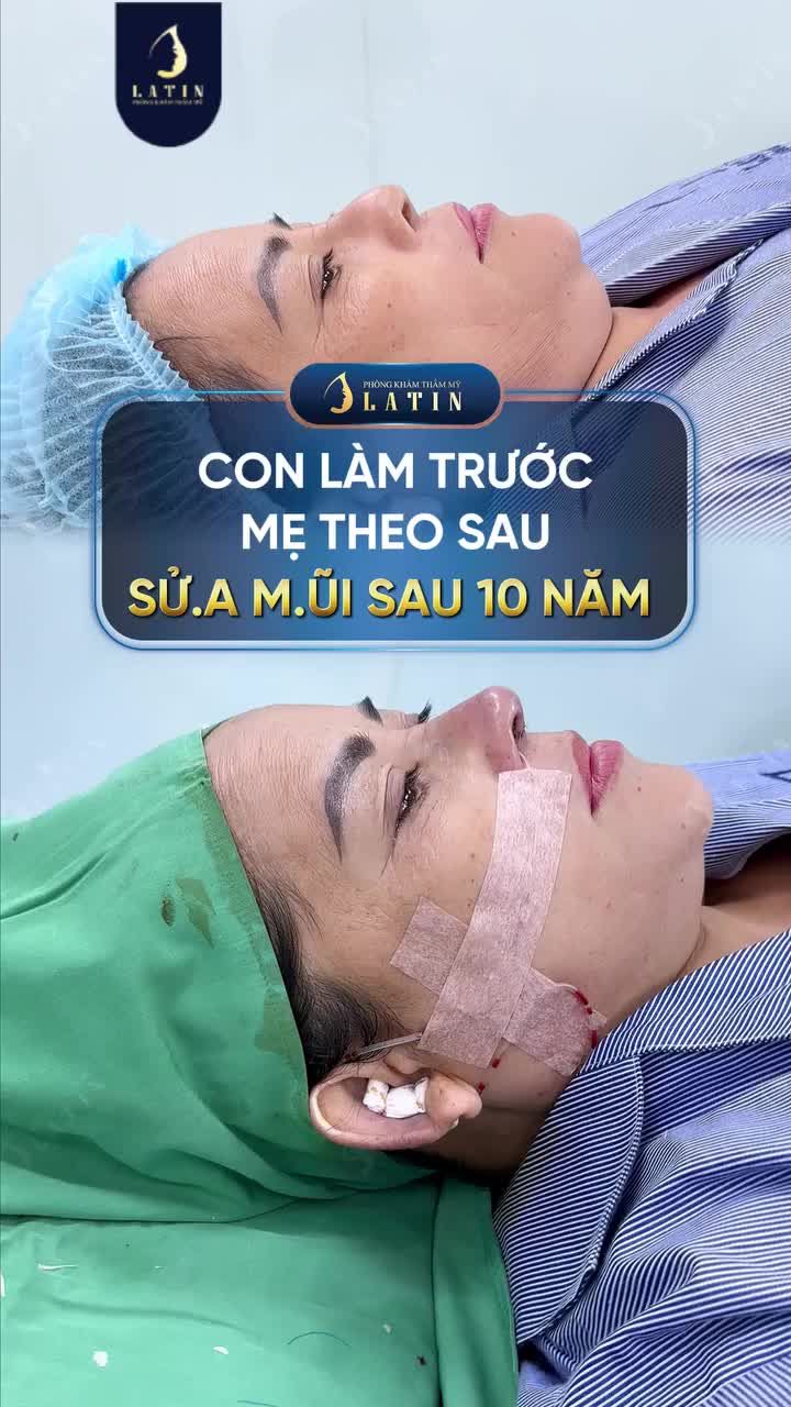 CON LÀM TRƯỚC, MẸ THEO SAU - SỬA MŨI SAU 10 NĂM