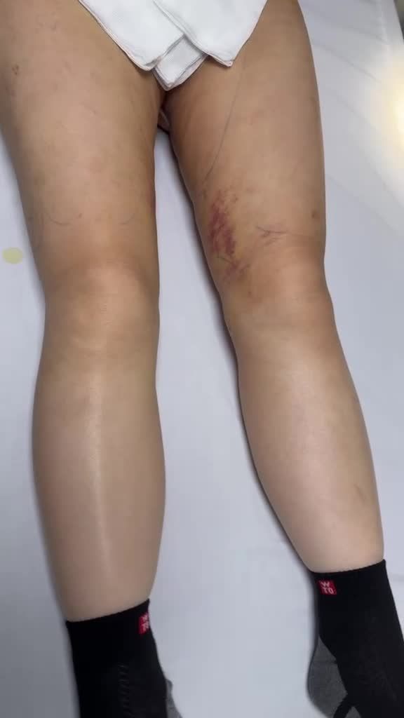 Hút mỡ đùi bụng, hậu phẫu sau 10 ngày đến cắt chỉ đã hồi phục tốt, bắt đầu lên form rõ nét với chân thon- thẳng- dài và bụng eo thon !