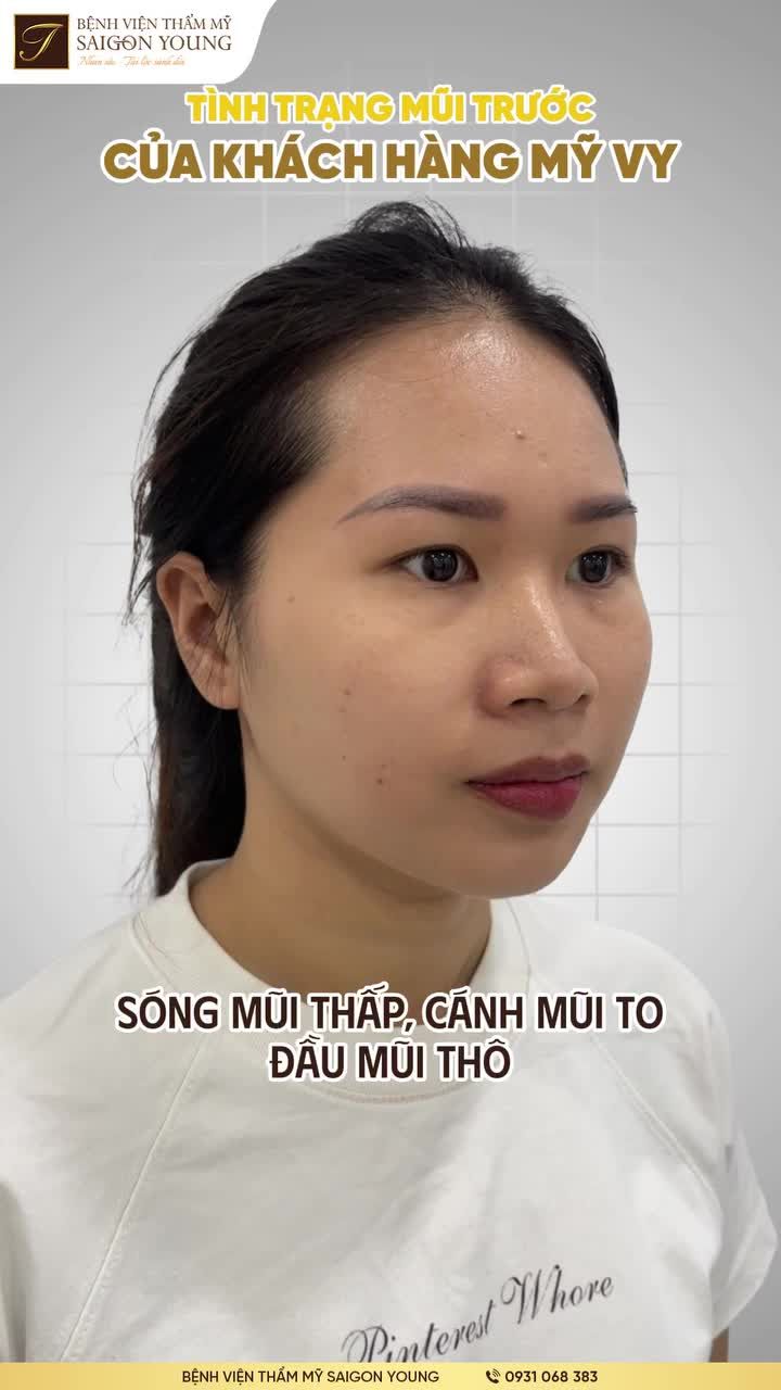 Hình ảnh NÂNG MŨI SAU 3 THÁNG