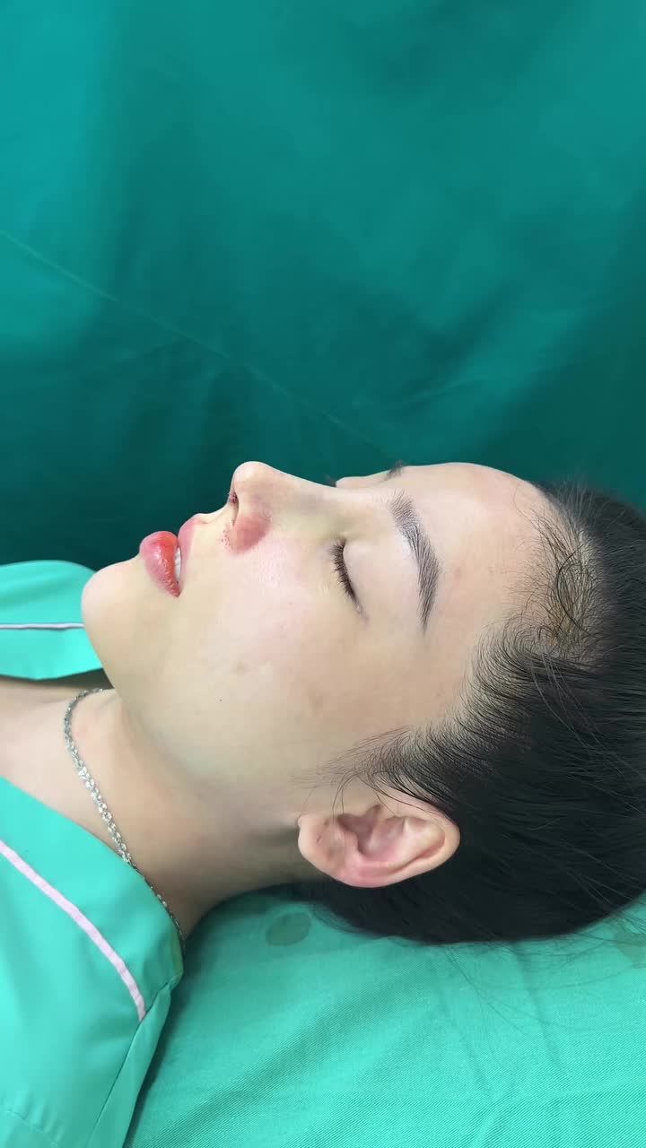 Case Nâng mũi cấu trúc rút chỉ vừa hoàn thành
