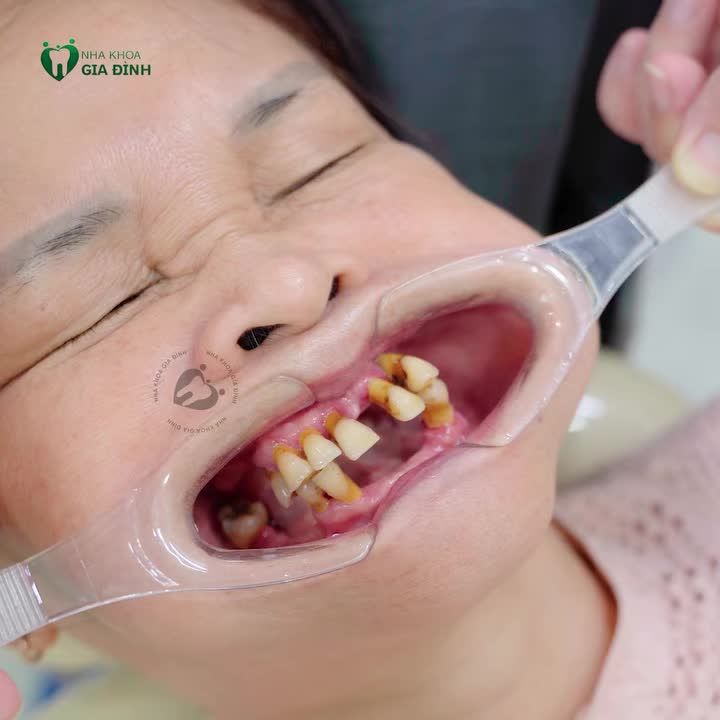 HÀM GIẢ THÁO LẮP CHỈ LÀ GIẢI PHÁP TẠM THỜI - TRỒNG RĂNG CỐ ĐỊNH ĐỂ LẤY LẠI KHẢ NĂNG ĂN NHAI