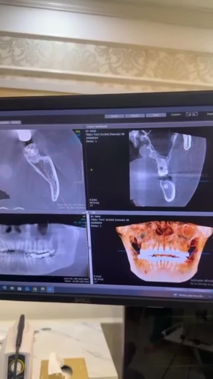 NHỔ RĂNG KHÔN NHANH - ÊM - CHUẨN Y KHOA