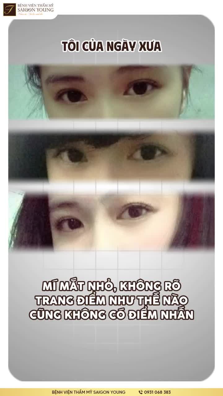 Cận cảnh vẻ đẹp cuốn hút sau khi Cắt mí từ đôi bàn tay Bác sĩ Tươi.