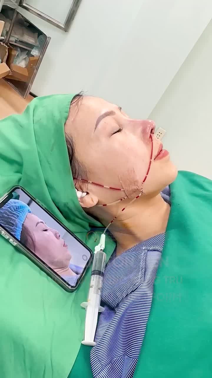 SAI LẦM TỐN TIỀN NÂNG MŨI KHÔNG DỰNG TRỤ CHỈ DÙNG SỤN SURGIFORM