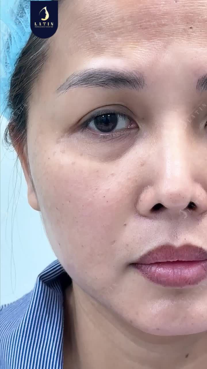 KHI CẮT MẮT KHÔNG CHỈ ĐỂ TẠO MẮT HAI MÍ