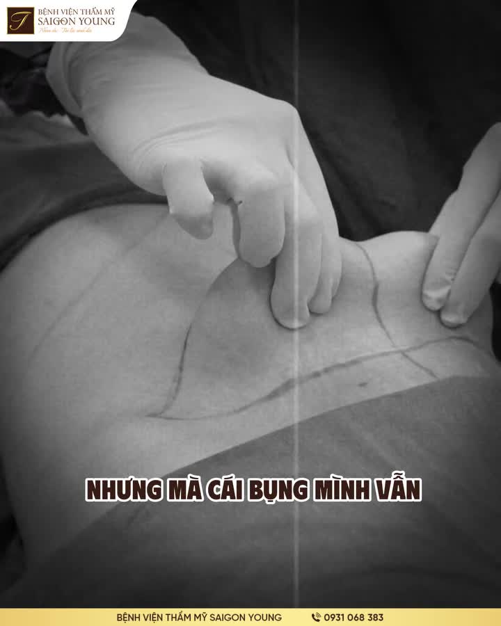 TÁI TẠO DA THÀNH BỤNG LÀ GIẢI PHÁP DUY NHẤT