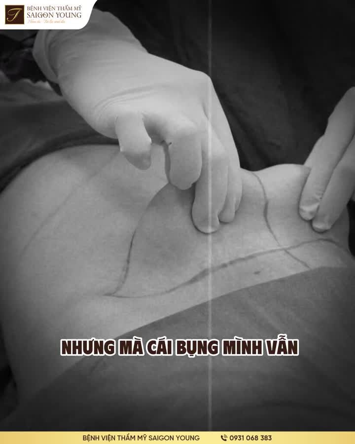 TÁI TẠO DA THÀNH BỤNG LÀ GIẢI PHÁP DUY NHẤT