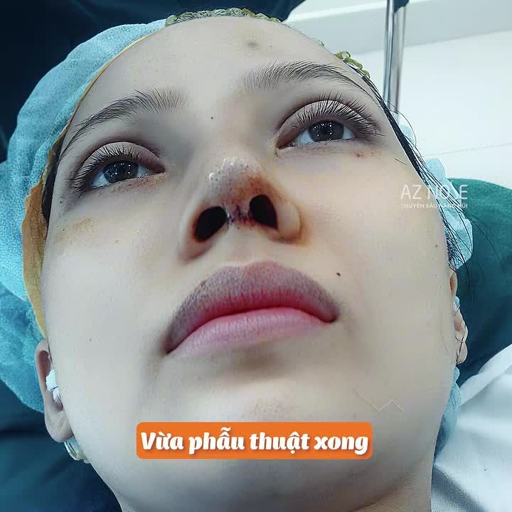 Combo mí - mũi - cằm: Thay đổi toàn diện trong 1 lần!