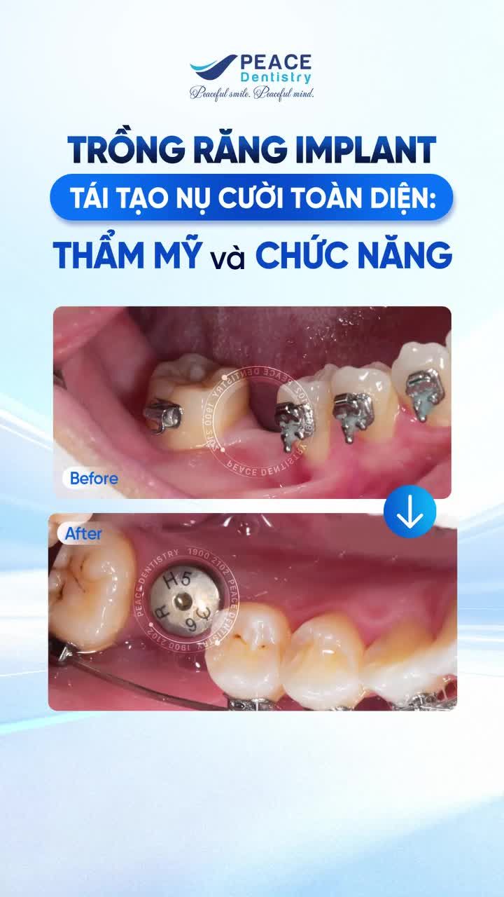 Dưới đây là ca lâm sàng niềng răng kết hợp trồng implant đang trong thời gian chờ phục hình sau khi đã cắm trụ tại Peace Dentistry.