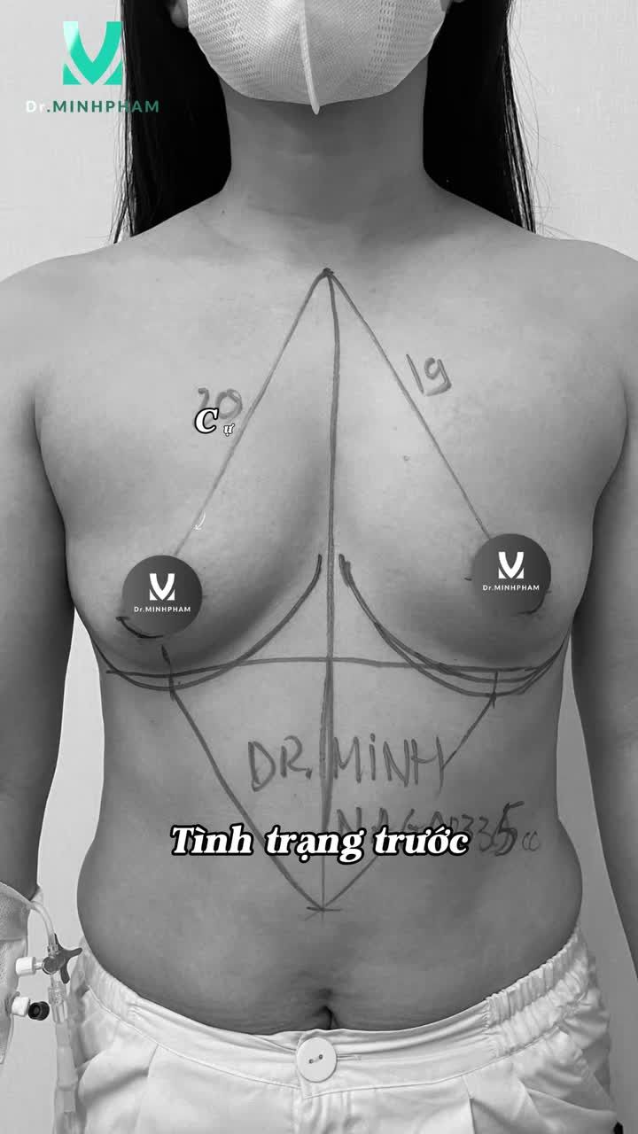 CÙNG XEM SỰ THAY ĐỔI SAU NÂNG NGỰC Ở VIDEO DƯỚI ĐÂY