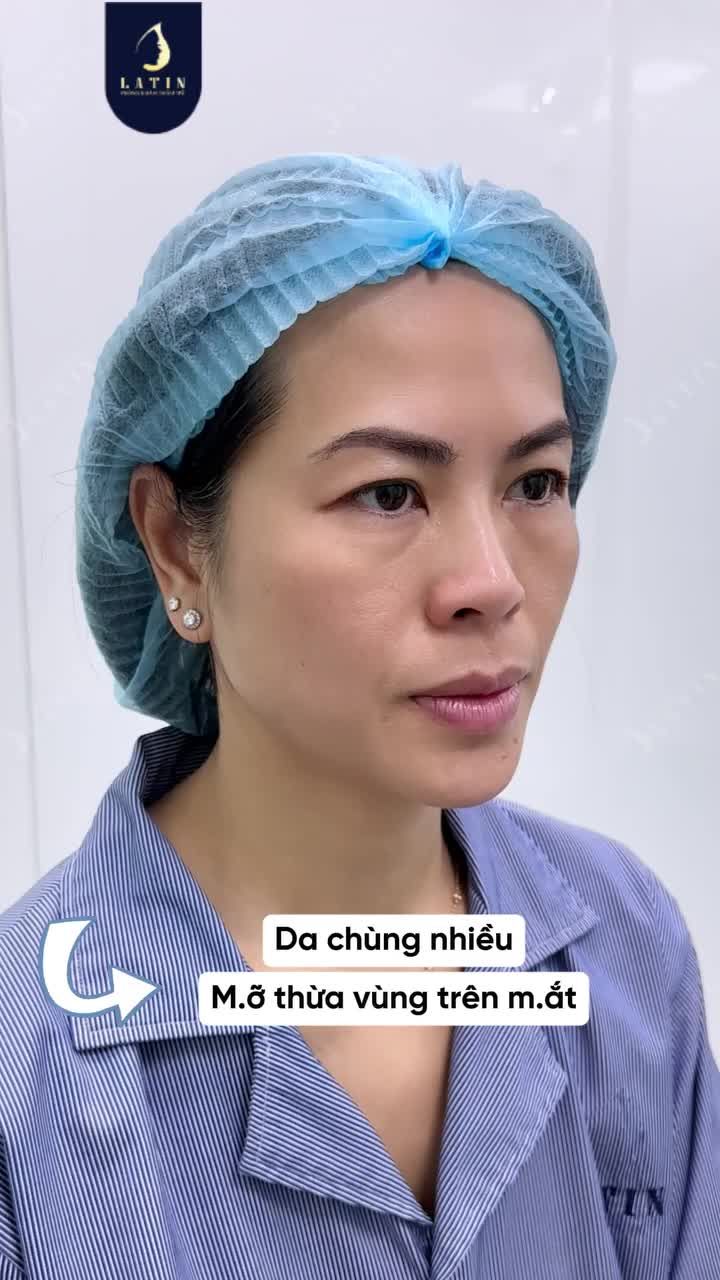 VÙNG MẮT THAY ĐỔI MÀ KHÔNG ĐỤNG NẾP MÍ?